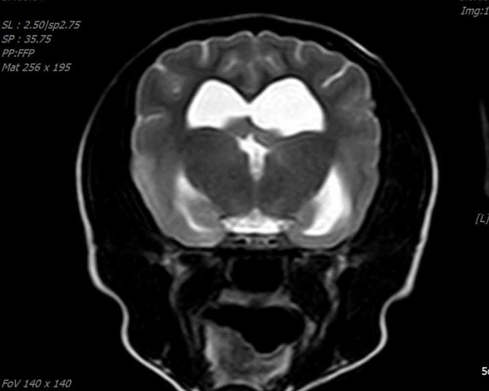 뇌종양 MRI