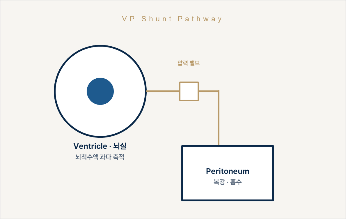 수두증과 VP 션트 수술